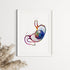 Intragastric Balloon for Weight Loss Watercolor Art Print